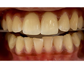 An extreme close-up photograph of a person's mouth showing yellowed teeth with some staining, and a partial view of a red tongue and gums.
