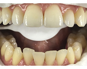 The image displays a close-up view of an open mouth with teeth showing signs of wear and discoloration, possibly due to aging or dental issues.