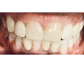 The image shows a close-up of a person's teeth with an open mouth, revealing a smile.