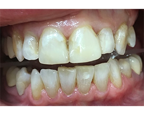 The image shows a close-up view of a person's mouth with teeth showing signs of decay and discoloration, indicating poor oral hygiene.