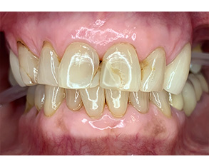 The image shows a close-up view of a person's mouth with yellowed teeth and an unhealthy gum line, suggesting dental neglect or a need for professional oral care.