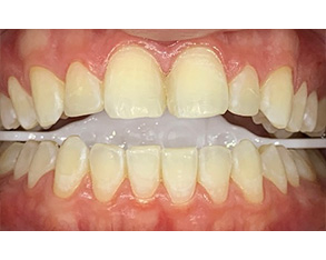The image shows a set of four photos side by side of a person's teeth with varying levels of discoloration, from yellow to red, highlighting dental care issues such as staining and decay.
