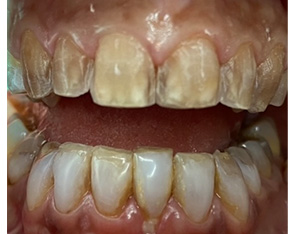 The image shows a close-up view of a person's mouth with severely discolored teeth, including yellow staining and some areas of decay or damage, suggesting poor oral hygiene or dental health issues.