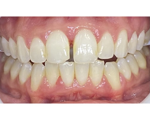 The image displays two close-up views of a person s teeth with an emphasis on dental health issues such as tooth decay, discoloration, and gum disease.