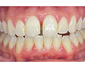 The image shows two close-up photographs of a person's mouth with teeth that appear to be discolored or stained, likely due to dental issues such as decay or poor oral hygiene.