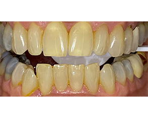 The image shows a close-up view of a person's teeth with a focus on yellowing and staining, likely for dental care or cosmetic purposes.