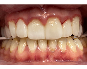 The image shows a close-up view of a person's teeth with discoloration, particularly yellowing, and some decay, displayed against a plain background.