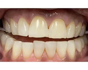 The image shows two close-up photographs of teeth with varying levels of discoloration and decay.