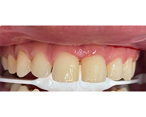 The image displays two photographs of dental implants with a focus on their color and condition, showcasing the before and after state of dental restoration.