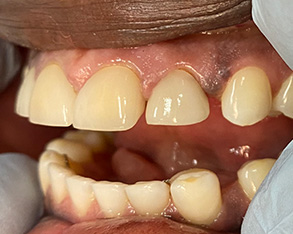 The image shows a close-up view of a person's mouth with multiple teeth showing signs of decay and discoloration, with some teeth missing.