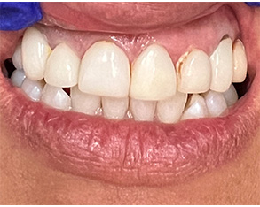 The image shows a close-up of a person's mouth with white teeth and gums, displaying a smile with some yellowing on the front teeth.