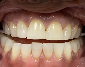 The image displays a close-up of a person s teeth with a focus on yellowing and staining, likely intended for dental care services.