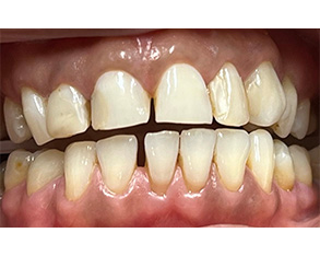 The image shows two photos side by side of a person's teeth before and after dental treatment, highlighting the transformation from yellowed to clean, white teeth.