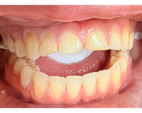 The image shows a close-up view of a person's mouth with teeth that appear discolored and possibly decayed, with one tooth prominently missing its enamel, revealing the underlying dentin.