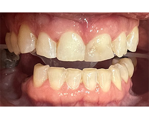 The image shows two photographs of an open mouth displaying yellowed teeth with some staining visible on the lower front teeth, one of which appears to be missing a filling.