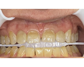 The image shows a person s teeth being cleaned by a dental hygienist using an ultrasonic cleaning device, with water spraying onto the teeth.