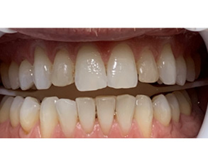 The image shows a close-up view of a person s teeth with an open mouth, revealing yellowing and staining on the teeth.
