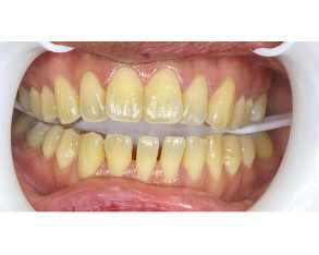 The image shows a close-up view of a person s teeth with yellow staining, which appears to be from nicotine use, set against a white background.