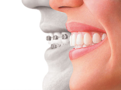 The image shows a close-up of a smiling person s teeth, with a split view on either side  one half showing a healthy set of teeth, and the other half revealing a mouth with braces.